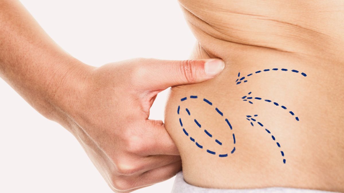Vaser Liposuction Recovery Timeline & Healing Tips - DRV Clinic