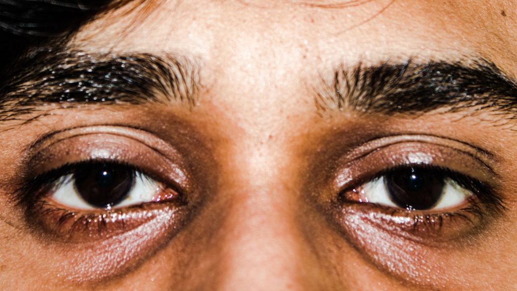 Best Dark Circles Treatment Clinic London Guide