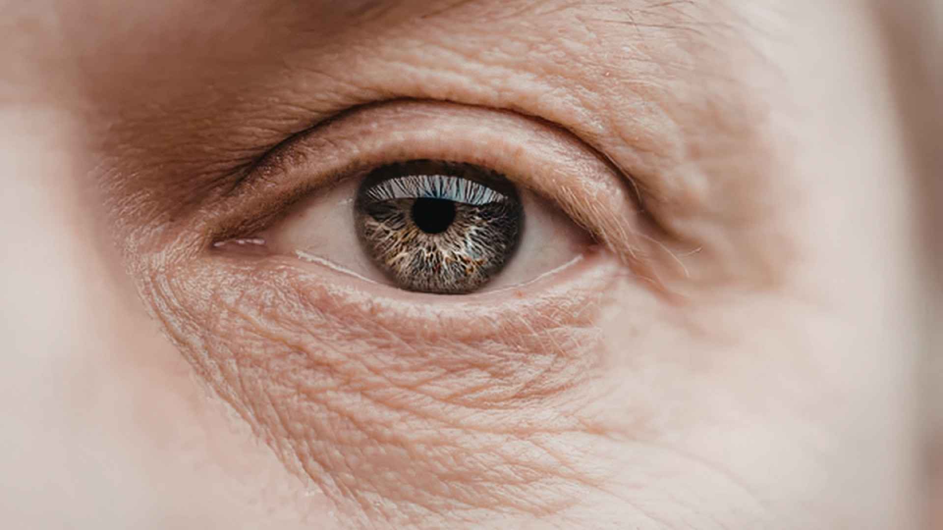 Non-surgical blepharoplasty treatment for hooded eyes and eyelid laxity in London